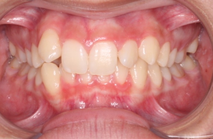before Image
