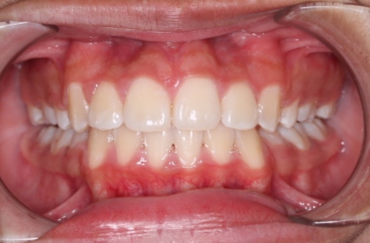 after Image