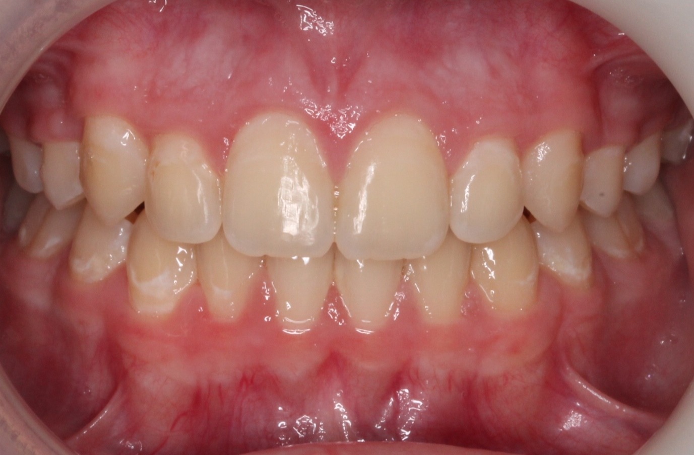 after Image