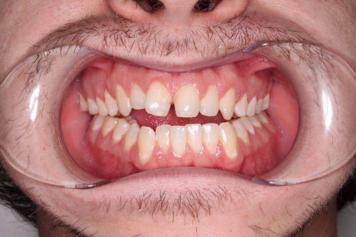 before Image