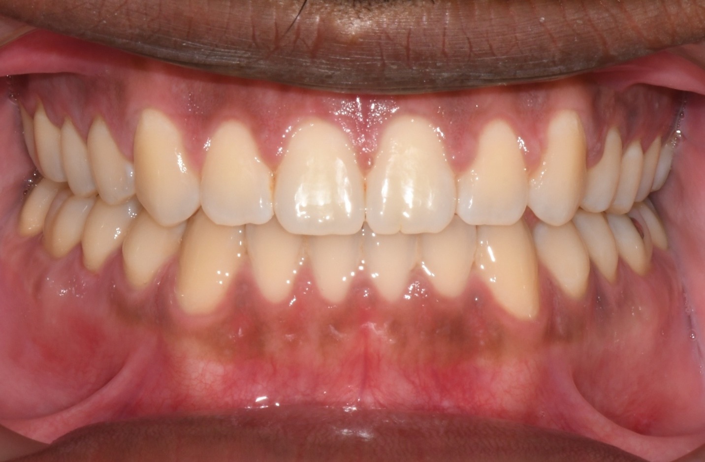 after Image